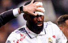 Врятував команду ціною власного здоров'я: гравцеві Реала наклали 20 швів після гри з Шахтарем