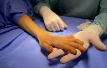 Львівські медики прооперували руку жінки з генетичною патологією: мутацію вивчатимуть у Британії (фото)