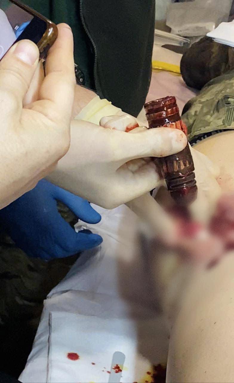 Украинские медики спасли бойца ВСУ: в его теле была часть снаряда / фото УНИАН