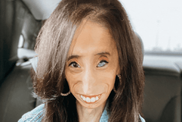 Стала кумиром: как самая уродливая девушка в мире изменила свою жизнь (фото)