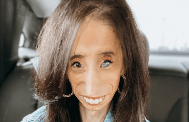 Стала кумиром: как "самая уродливая девушка в мире" изменила свою жизнь (фото)