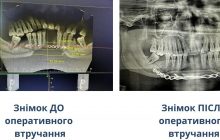 В Черновцах врачи сделали пациенту новую челюсть из ребра