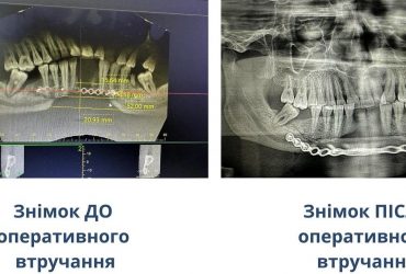 У Чернівцях лікарі зробили пацієнту нову щелепу з ребра