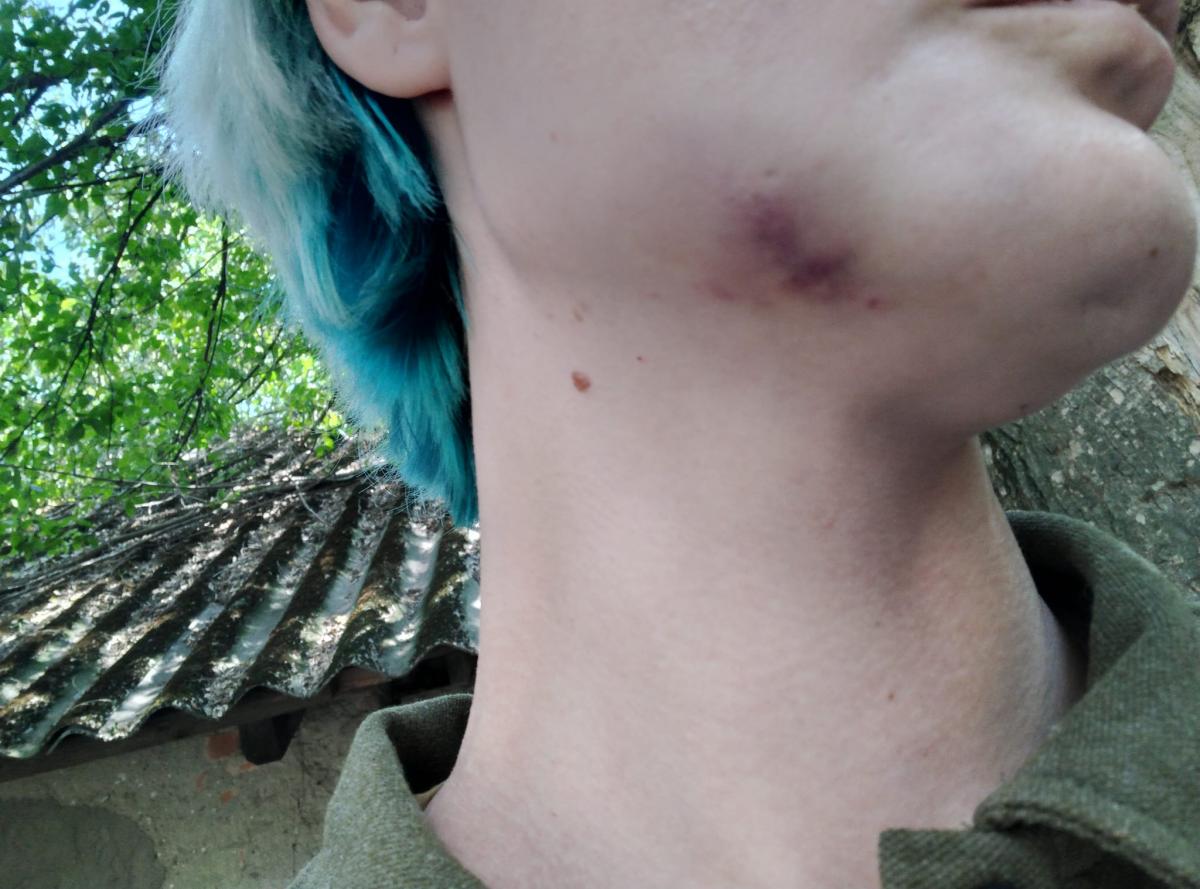 Пьяный работник военкомата в Ужгороде избил женщину / фото facebook.com/tatyana.novak.94 Пьяный работник военкомата в Ужгороде избил женщину / фото facebook.com/tatyana.novak.94