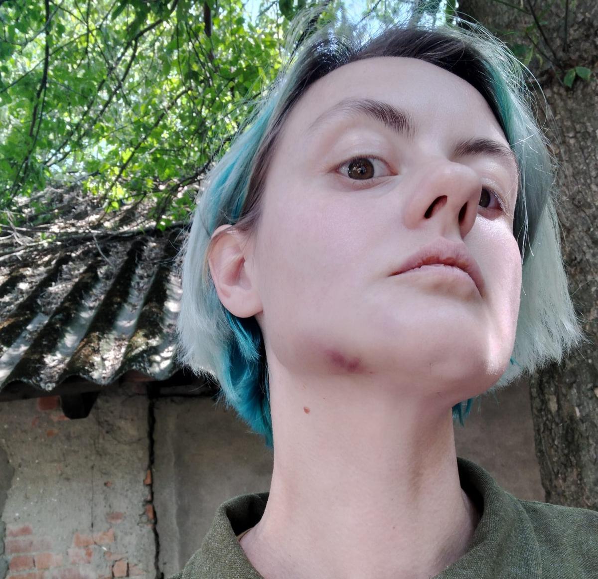 Тетяна Новак стверджує, що ужгородські правоохоронці намагаються всіляко зам'яти інцидент / фото Tatyana Novak Тетяна Новак стверджує, що ужгородські правоохоронці намагаються всіляко зам'яти інцидент / фото Tatyana Novak