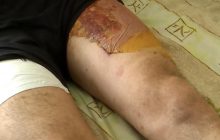 Медики показали, як рятують "найважчі" кінцівки бійців Запорізького фронту (відео)