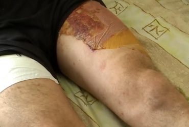 Медики показали, как спасают самые тяжелые конечности бойцов Запорожского фронта (видео)