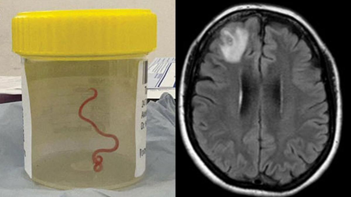 У мозку жінки знайшли живого хробака / фото Centers for Disease Control and Prevention