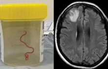 Вперше у світі у мозку жінки знайшли живого хробака: які симптоми у неї були (фото)