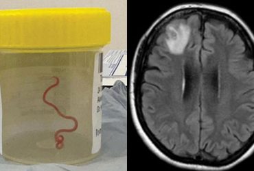 Впервые в мире в мозгу женщины нашли живого червя: какие симптомы у нее были (фото)