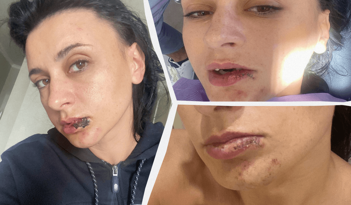 Після чергових лікарів у лікарні дівчині довелося наново перешивати пошкоджену губу / колаж УНІАН, фото instagram.com/navka.ua Після чергових лікарів у лікарні дівчині довелося наново перешивати пошкоджену губу / колаж УНІАН, фото instagram.com/navka.ua