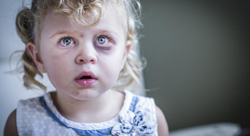 Синяки и царапины: в Киеве воспитательница избила подопечную в детсаду ...