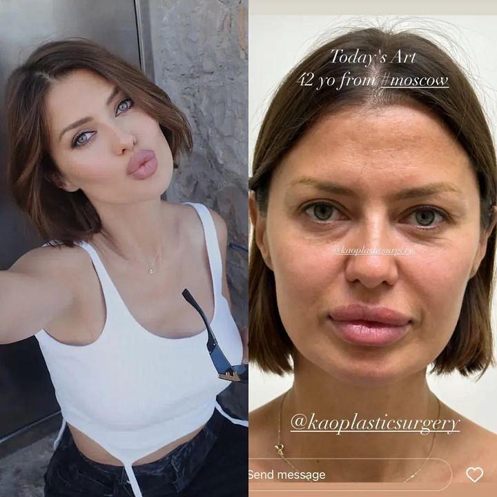 Скандальная София Стужук шокировала лицом после неудачной пластики (фото)