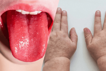 Потужний спалах скарлатини в Києві: головний симптом і методи лікування