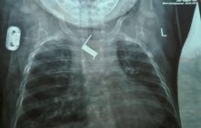 В Одесі врятували малюка з пружиною у стравоході: до того крихітку два тижні "лікували" від бронхіту