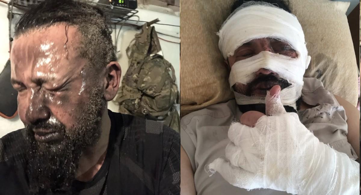 Известный российский шоумен получил ожог лица на войне в Украине (фото) Известный российский шоумен получил ожог лица на войне в Украине (фото)