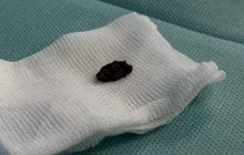 Во Львове врачи с сердца девушки вытащили осколок российской ракеты (фото)