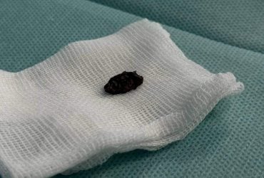 У Львові лікарі з серця дівчини витягнули осколок російської ракети (фото)