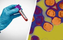 В Европе зафиксировали новый случай оспы mpox: больных может быть значительно больше