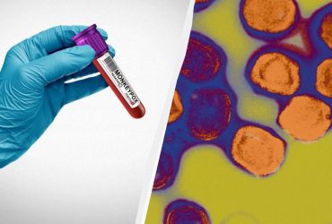 У Європі зафіксували новий випадок віспи mpox: хворих може бути значно більше