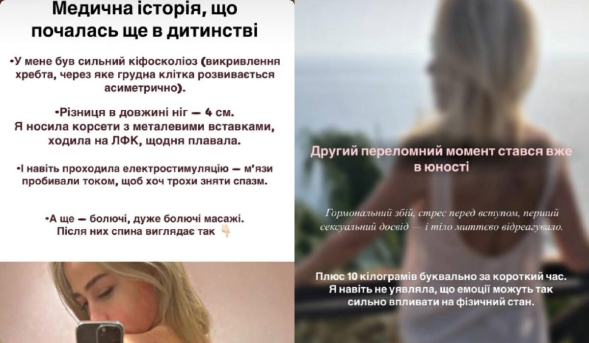 Інна Білень зробила пластику грудей і підборіддя / колаж УНІАН, скріншоти Instagram Інна Білень зробила пластику грудей і підборіддя / колаж УНІАН, скріншоти Instagram