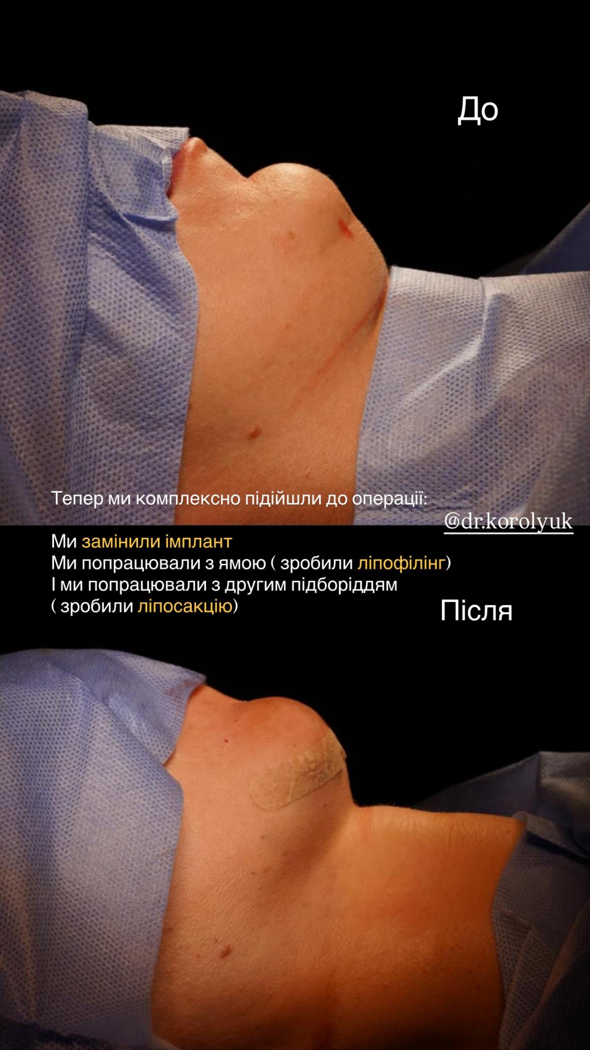 Жена Павлика показалась после еще одной пластической операции / фото instagram.com/repyahovakate Жена Павлика показалась после еще одной пластической операции / фото instagram.com/repyahovakate