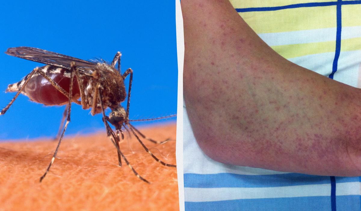 Небезпечна тропічна інфекція загрожує майже всій Європі, - The Guardian