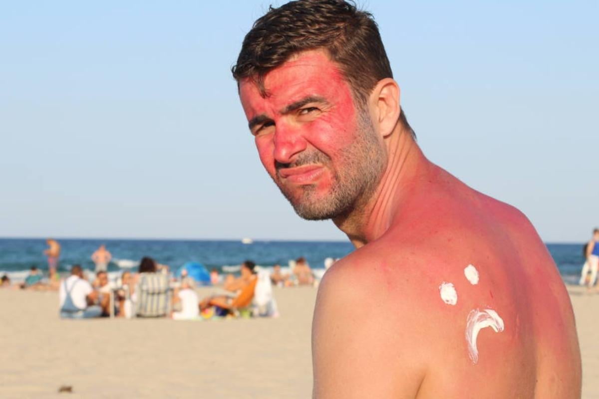 Нове дослідження перевернуло уявлення про те як насправді виникають сонячні опіки