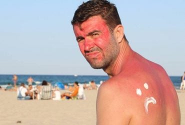 Новое исследование перевернуло представления о том, как на самом деле возникают солнечные ожоги