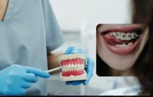 Лікар-ортодонт пояснила, які брекети краще ставити: скільки це насправді коштує