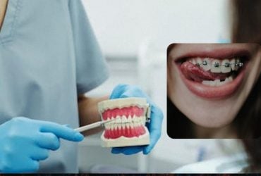 Лікар-ортодонт пояснила, які брекети краще ставити: скільки це насправді коштує